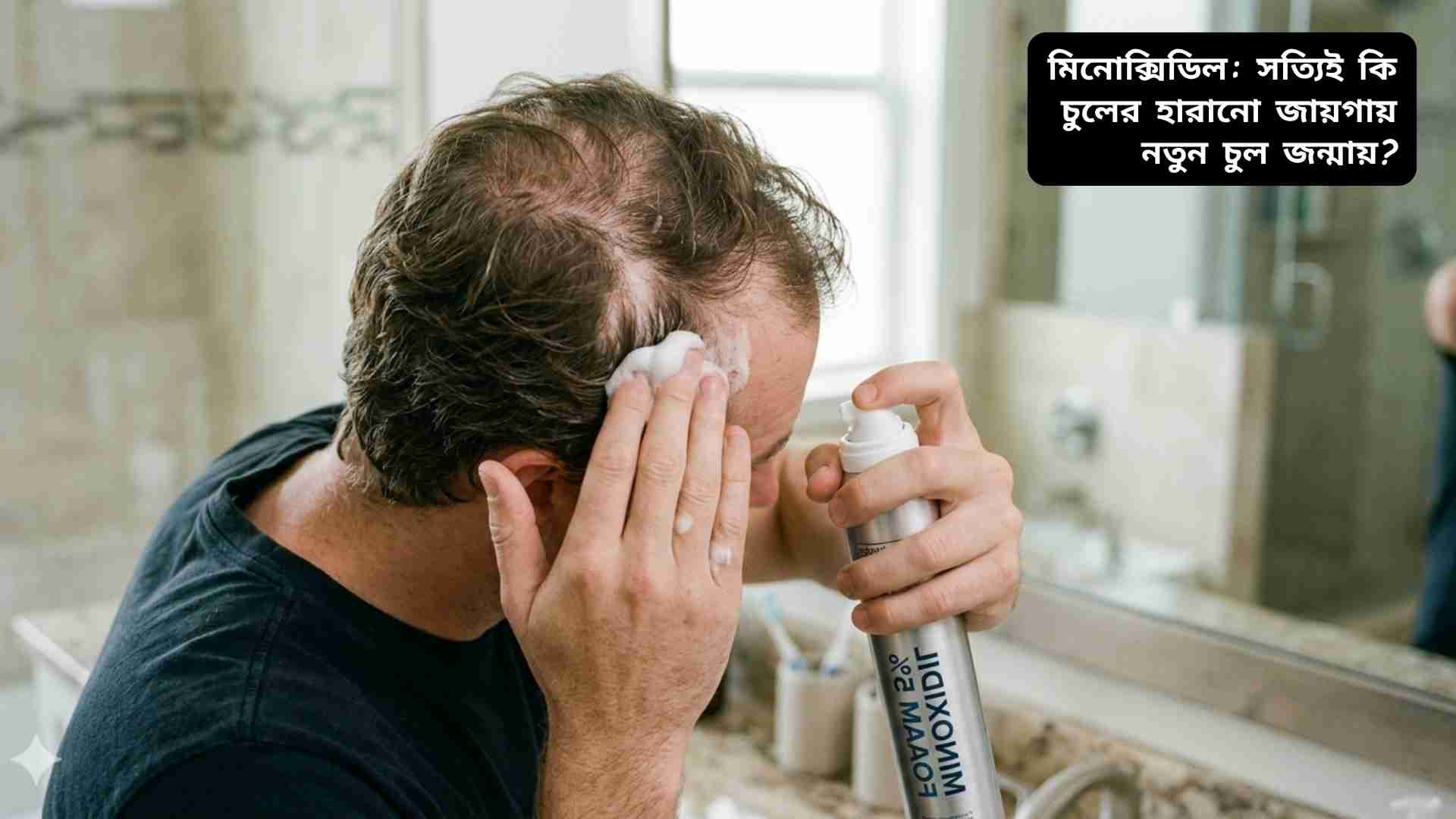 মিনোক্সিডিল ব্যবহার করে চুল পুনঃউৎপাদনের সম্ভাবনা ও ফলাফল প্রদর্শন করা হচ্ছে।